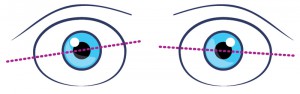 disallineamento-occhi