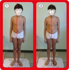 Dispercezione e scoliosi