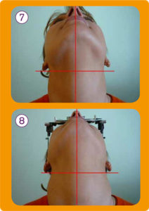 Intervento terapeutico vertebre cervicali