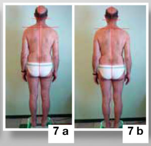 Terapia per sbandamento omolaterale