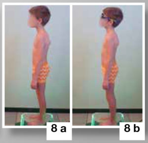 Terapia per scapole alate